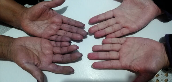 esclerodermia